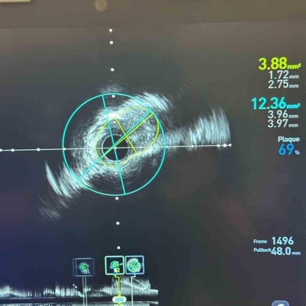 Damar içi görüntüleme (IVUS) ile stentleme işlemi-2